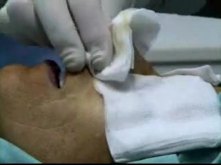 Rinoplastyka zbyt długiego nosa - wycięcie typu T