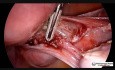 Laparoskopowa histerektomia z appendektomią z podświetlanym cewnikiem moczowodowym