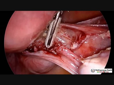 Laparoskopowa histerektomia z appendektomią z podświetlanym cewnikiem moczowodowym
