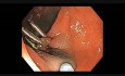 Kolonoskopia: jak przeprowadzić endoskopową resekcję śluzówkową - zmiana F