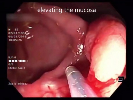 Polipowata zmiana typu LST-G (ang. laterally spreading tumor, granular) - endoskopowa fragmentaryczna resekcja śluzówkowa (pEMR)