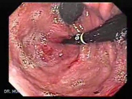 Przełyk Barretta i gruczolakorak połączenia żołądkowo-przełykowego - dwa endoskopy widoczne w inwersji