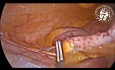 Laparoskopowe usunięcie wyrostka robaczkowego