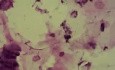 Polip szyjki macicy - Cytopatologia