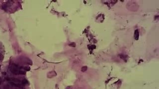 Polip szyjki macicy - Cytopatologia