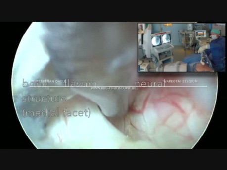 Endoskopowy zabieg usunięcia przepukliny kręgosłupa oraz dekompresja korzenia S1