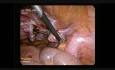 Totalna histerektomia laparoskopowa- TLH