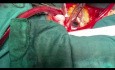 Zmodyfikowana rekonstrukcja zastawki mitralnej u pacjenta z małym lewym przedsionkiem