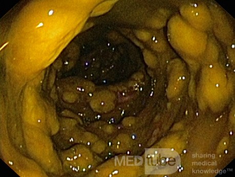 Rzekomobłoniaste zapalenie jelita grubego - obraz endoskopowy