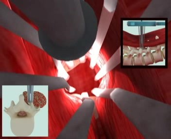 System do operacji neurochirurgicznych (rama z zestawem retraktorów mózgowych)