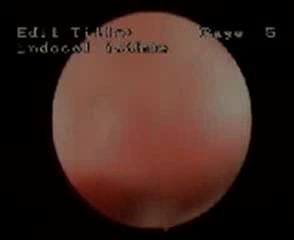 Histeroskopowy obraz zaniku endometrium