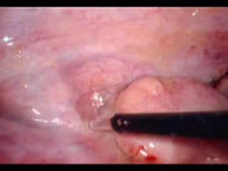 Perforacja okrężnicy z zapaleniem otrzewnej - laparoskopia (28 z 46)