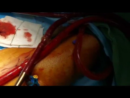  Transplantacja serca unikawalna u pacjenta po przedłużonej terapii ECMO