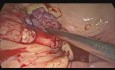 Rewizja zespolenia po laparoskopowej przedniej resekcji