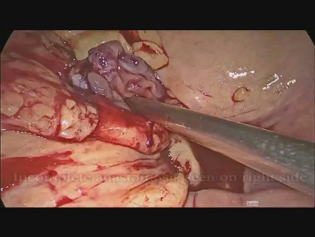 Rewizja zespolenia po laparoskopowej przedniej resekcji