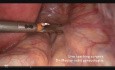 Histerektomia subtotalna laparoskopowa