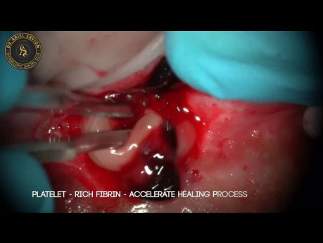 Mikrochirurgia z użyciem laserów o rożnej długości fali - gingiwektomia, frenektomia, apikoektomia 