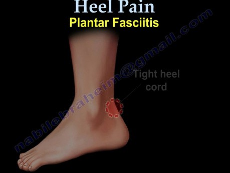 Zapalenie powięzi stopy i ból pięty