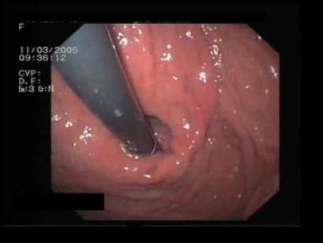 Przepuklina rozworu przełykowego w endoskopii