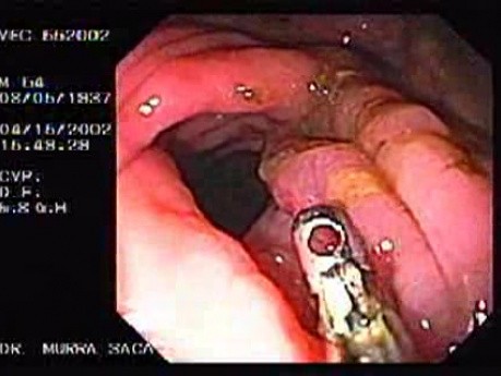 Zespół Zollingera-Ellisona - wrzód żołądka, wrzody żołądka i przetoka żołądkowo-okrężnicowa (8 z 21)
