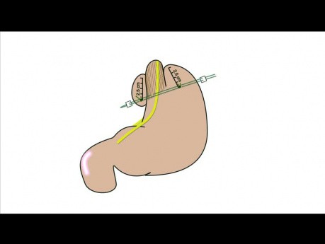 Geometry Fundoplication App - instruktaż, rozdział 08 – Animacja przebiegu fundoplikacji