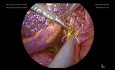 Nieprawidłowy prawy przewód wątrobowy wchodzący do krótkiego przewodu pęcherzykowego zdiagnozowany podczas cholecystektomii laparoskopowej