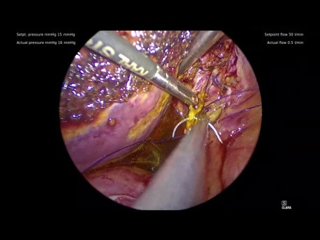 Nieprawidłowy prawy przewód wątrobowy wchodzący do krótkiego przewodu pęcherzykowego zdiagnozowany podczas cholecystektomii laparoskopowej