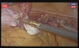 Live 3D- Całkowita laparoskopowa histerektomia, leczenie mięśniaków macicy