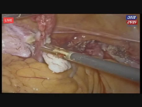 Live 3D- Całkowita laparoskopowa histerektomia, leczenie mięśniaków macicy