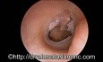 Perforacja błony bębenkowej z tympanosklerozą i przedni kostny garb nosowy