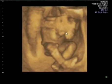 USG w ciąży - wideo
