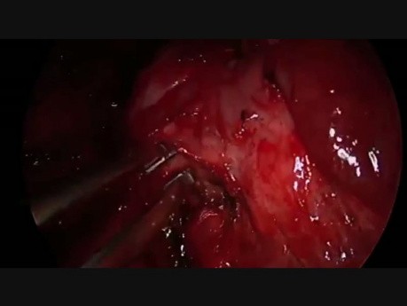 Wideotrakoskopowa segmentektomia z jednego cięcia w przypadku wrodzonej gruczolakowatości torbielowatej płuca