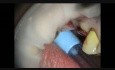 Mikrochirurgia implantologiczna: podniesienie dna zatoki szczękowej