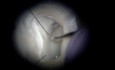 Ujście kanału MB2 w trzonowcu szczęki pod mikroskopem