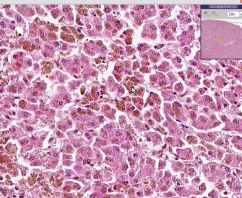 Wątroba, węzły chłonne - hemochromatoza, hemosyderoza