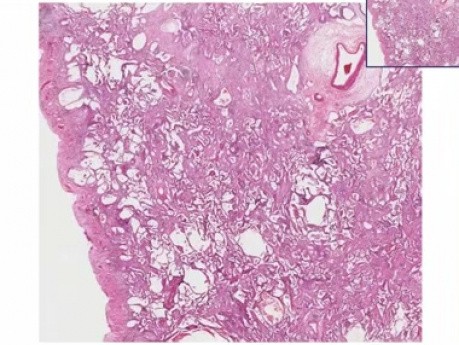 Rozproszone zwłóknienie śródmiąższowe - histopatologia - płuco