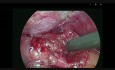 Cholecystektomia laparoskopowa (metoda Critical View of Safety)