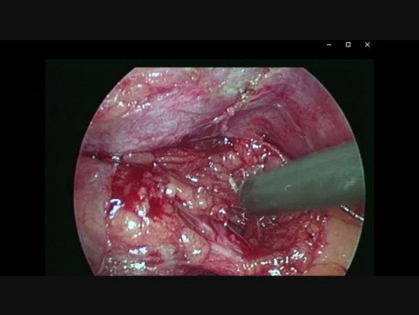 Cholecystektomia laparoskopowa (metoda Critical View of Safety)