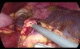 Splenektomia laparoskopowa u pacjenta z agenezją zawiązka grzbietowego trzustki - technika "Vessel First"