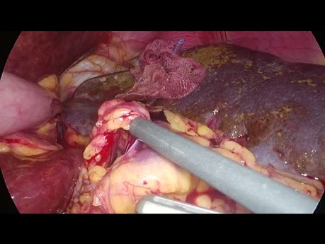 Splenektomia laparoskopowa u pacjenta z agenezją zawiązka grzbietowego trzustki - technika "Vessel First"