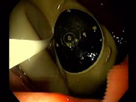 Endoskopowe usunięcie balonu (3 z 9)