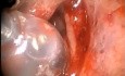 Światłowód Lumina - urządzenie ułatwiające balonową plastykę zatoki szczękowej