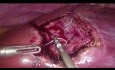 Laparoskopowa nieanatomiczna resekcja wątroby - "Diamond Technique"