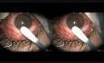 Filtracja przezrzęskowa jako operacja przeciwjaskrowa w oku po procedurze witreoretinalnej