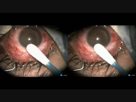 Filtracja przezrzęskowa jako operacja przeciwjaskrowa w oku po procedurze witreoretinalnej
