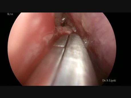 Resekcja polipa choanalnego 