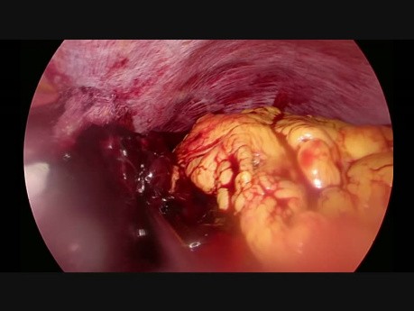 Krwawienie po laparoskopowej resekcji żołądka