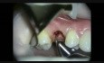 Chirurgia implantologiczna: Zastąpienie przetrwałego zęba mlecznego implantem.