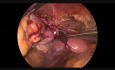 Laparoskopowa sigmoidektomia, częściowa resekcja jelita cienkiego i częściowa resekcja pęcherza moczowego 