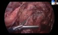 Gastrojejunostomia: zasady, techniki i pułapki